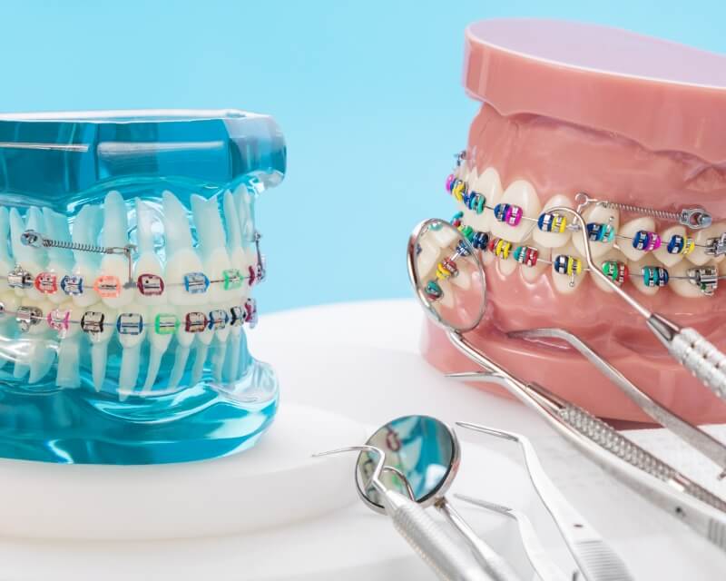 aparaty stale ortodontyczne radom