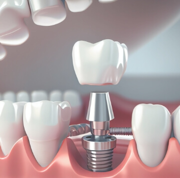 implantologia art dental