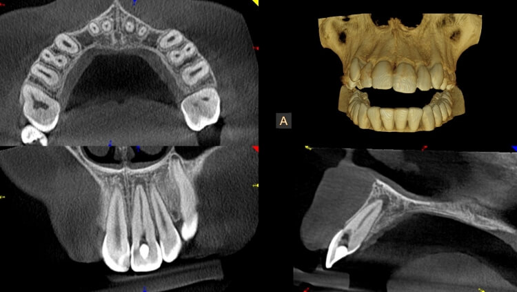 zdjęcie tomografia komputerowa zębów